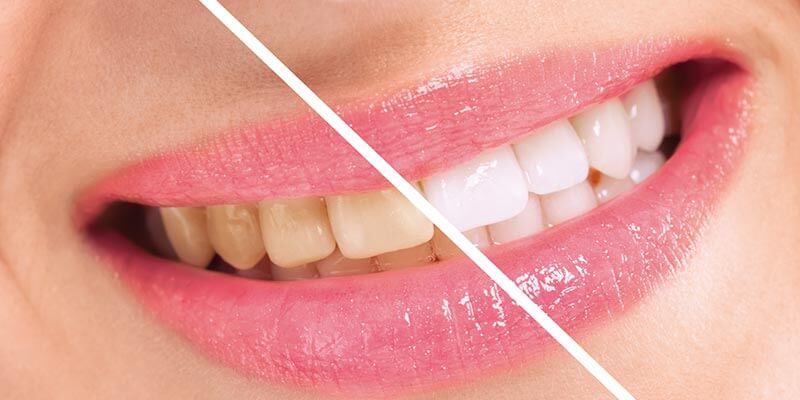Strahlend-weiße Zähne mit einem Zahnbleaching